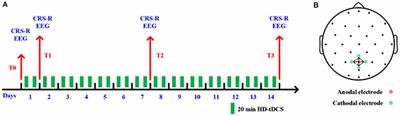 Effects of High-Definition Transcranial Direct-Current Stimulation on Resting-State Functional Connectivity in Patients With Disorders of Consciousness